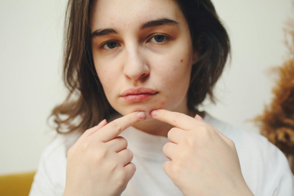 Adult Female Acne